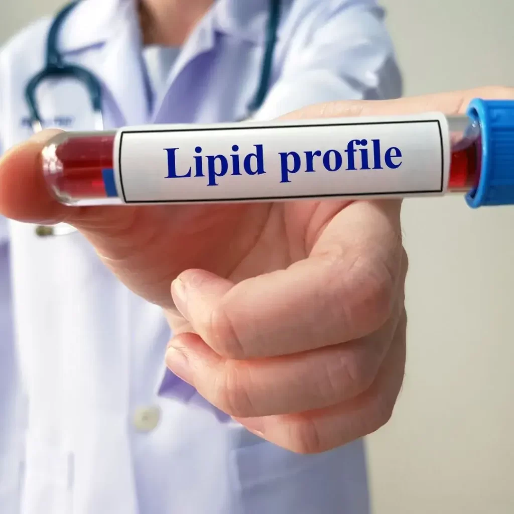 Lipid Profile Test in Dubai