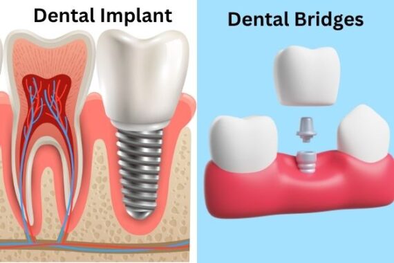 Dental Implants vs. Bridges