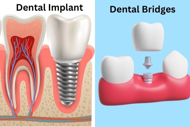 Dental Implants vs. Bridges