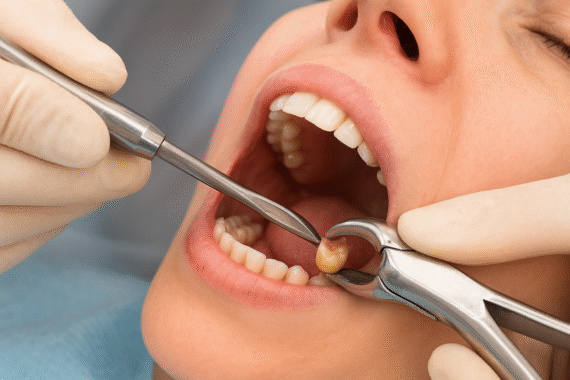 Tooth Extraction