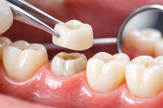 Dental Crowns Treatment